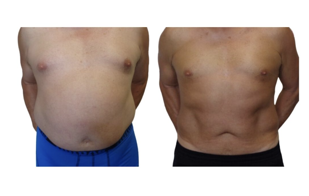 Before and after result 3