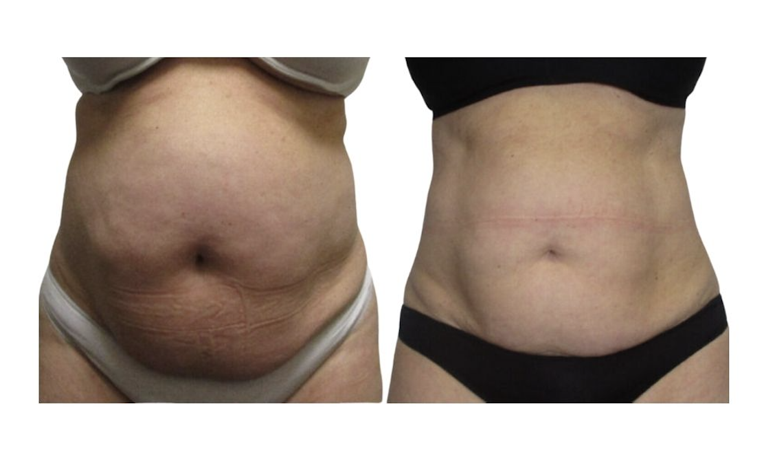 Before and after result 6