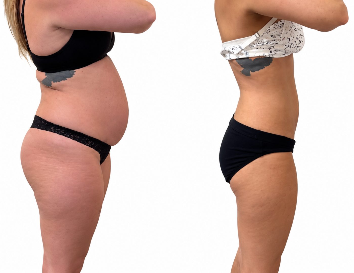 Body Sculpting & Contouring in Jupiter & West Palm Beach, FL