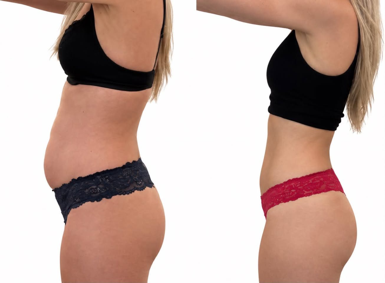 Body sculpting before and after result 3 — Jupiter & West Palm Beach