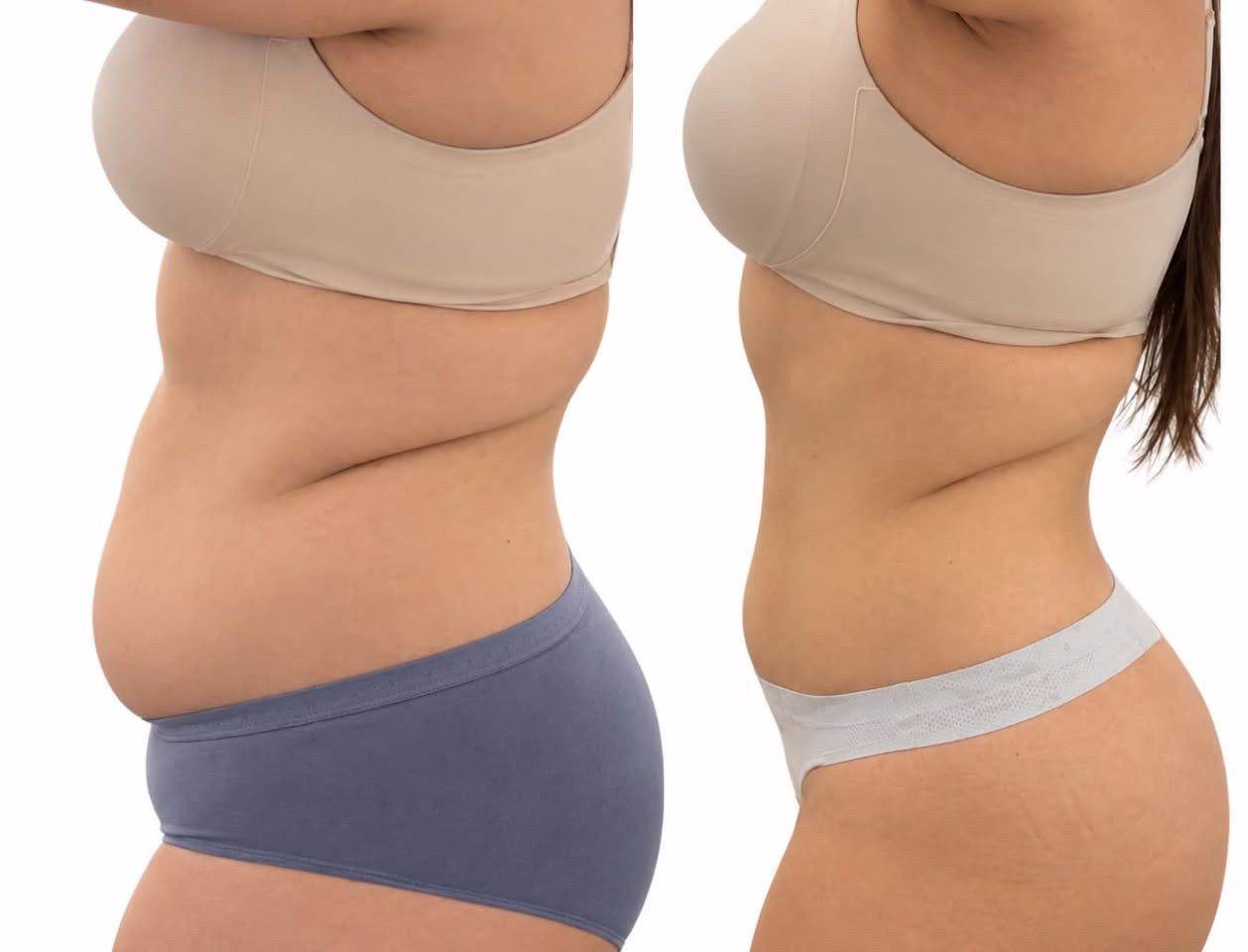 Body sculpting before and after result 5 — Jupiter & West Palm Beach