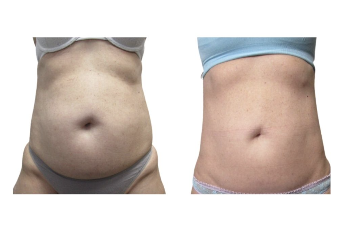 Weight loss and inch loss results at Palm Beach Body Sculpting & Skin
