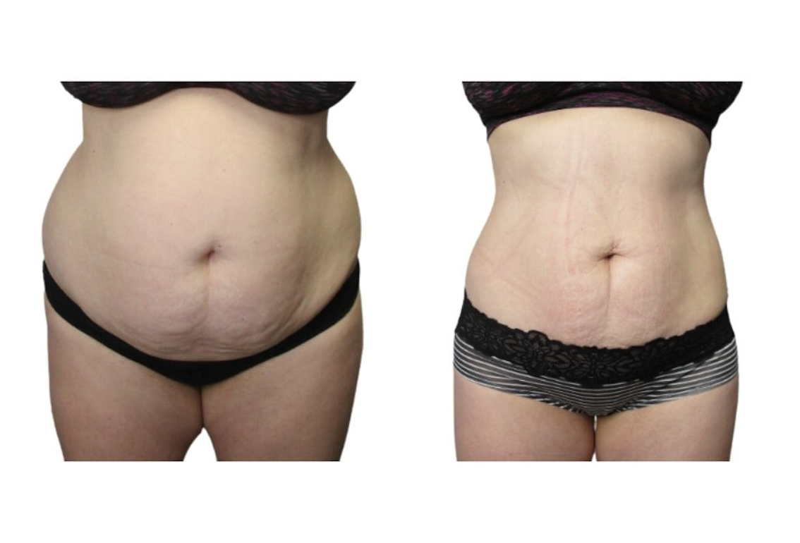 Weight loss and inch loss results at Palm Beach Body Sculpting & Skin