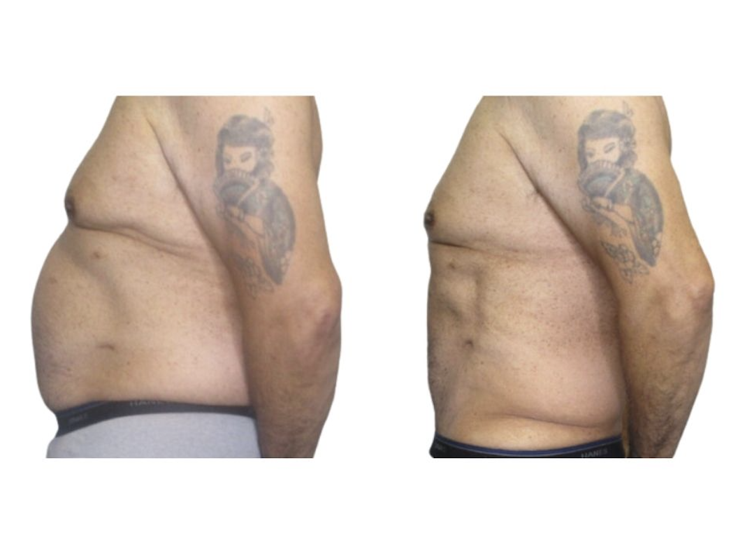 Weight loss and inch loss results at Palm Beach Body Sculpting & Skin